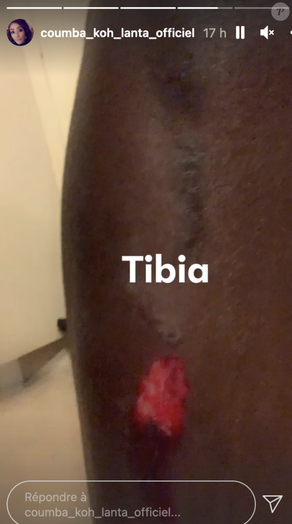 Coumba (Koh-Lanta) victime d'une chute à vélo, elle dévoile ses impressionnantes blessures - Instagram
