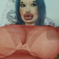 Andrea Ivanova : À seulement 24 ans, elle entame sa 27e augmentation des lèvres