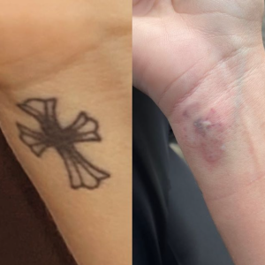 Thylane Blondeau s'est fait enlever un tatouage au laser. Story Instagram du 31 janvier 2022.