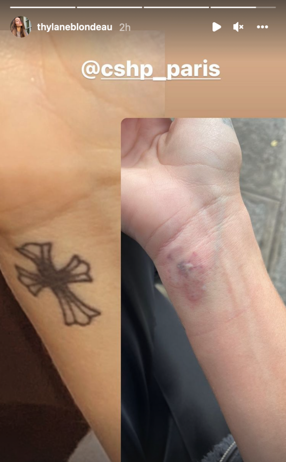 Thylane Blondeau s'est fait enlever un tatouage au laser. Story Instagram du 31 janvier 2022.