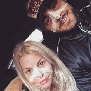 Jessica Thivenin et Thibault Garcia se sont fait refaire le nez, le 19 janvier 2018.