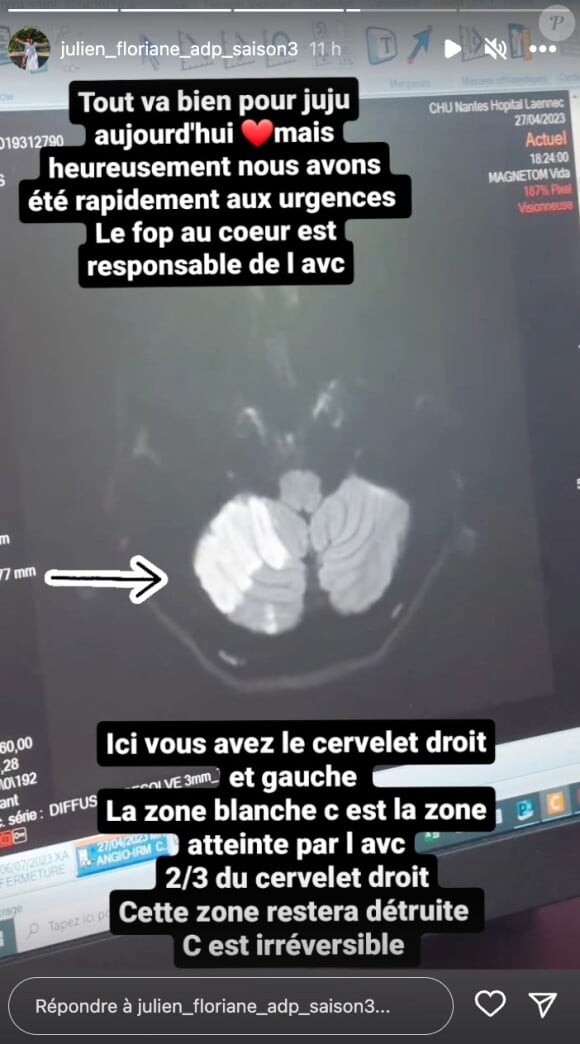 Floriane a alors relayé l'IRM de sa moitié. : "Ici vous avez le cervelet droit et gauche. La zone blanche c'est la zone atteinte par l'AVC. 2/3 du cervelet droit. Cette zone restera détruite. C'est irréversible".