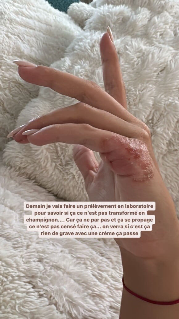 Elle a cependant prévu d'aller faire un prélèvement en laboratoire.
Giuseppa dévoilé sa main meurtrie sur Instagram.