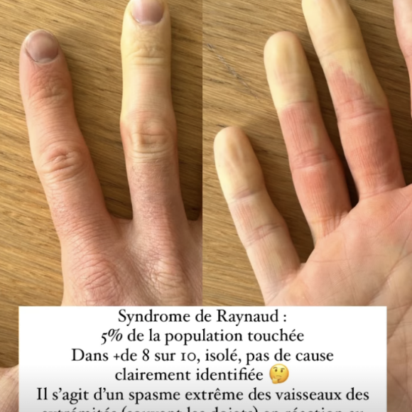 "Et au retour de cette sortie longue... Ça m'arrive souvent. C'est grave docteur ?", a-t-il écrit sur une image de ses doigts privés d'une bonne circulation du sang
Marine Lorphelin, son compagnon Stan atteint d'un trouble "gênant" et rare