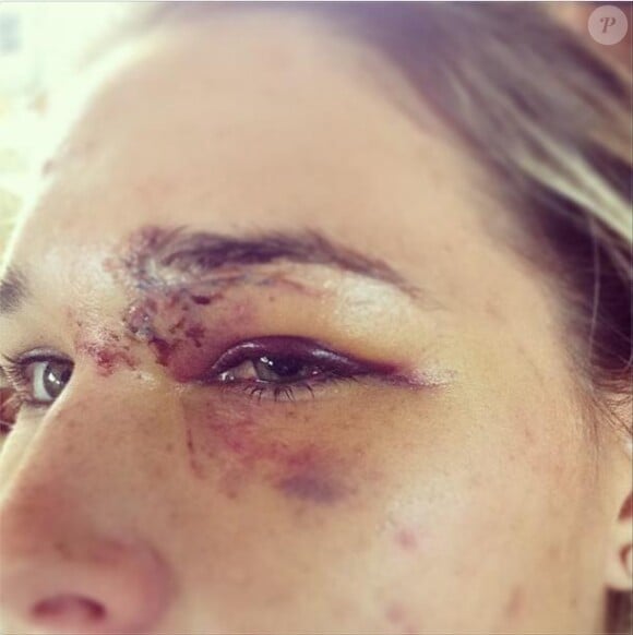 Morgan Beck et son oeil, après avoir reçu une balle de golf de son homme Bode Miller le 12 décembre 2012