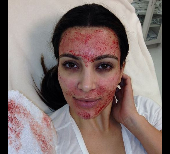 Kim Kardashian a posté une photo d'elle, le visage en sang, sur Instagram, le 11 mars 2013. Une énième victime de Twilight ?