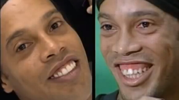 Ronaldinho opéré des dents : La star du foot montre son nouveau sourire