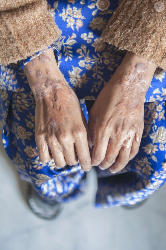 Les mains de Laxmi, victime d'une attaque à l'acide par un homme éconduit en 2005. Photo prise à New Delhi, le 4 février 2014.