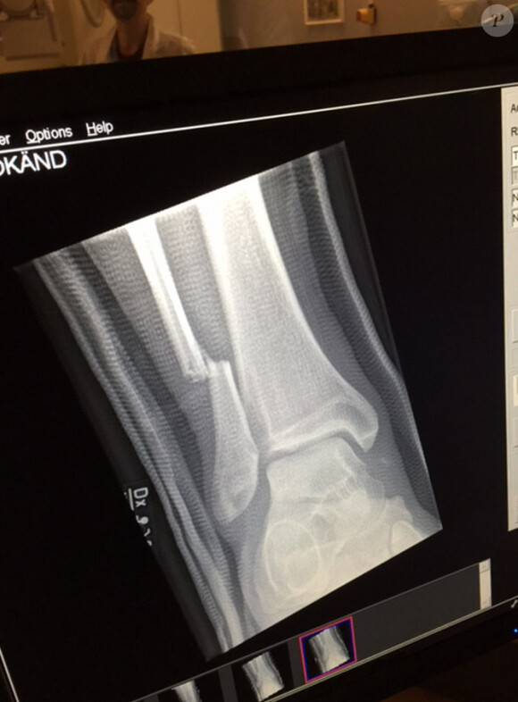 La fracture de la jambe de Dave Grohl lors d'un concert à Göteborg le 12 juin 2015. 