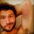 Christophe Beaugrand dévoile une photo de sa blessure sur Twitter. Le 16 juin 2016.