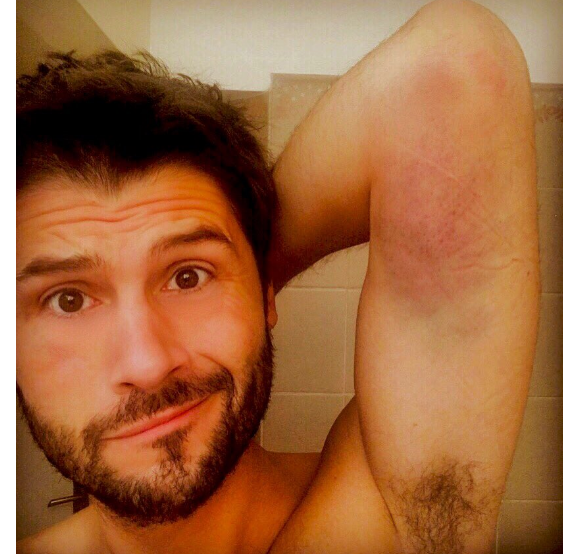 Christophe Beaugrand dévoile une photo de sa blessure sur Twitter. Le 16 juin 2016.