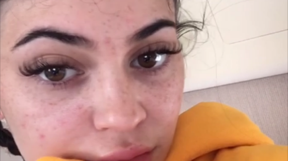 Kylie Jenner et ses tâches de rousseur : Sans make-up, elle n'est pas la même !