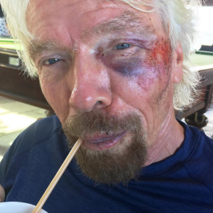 Richard Branson dévoile ses blessures sur Instagram après une violente chute à vélo, août 2016.