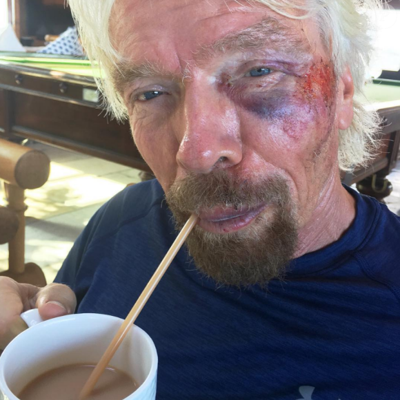 Richard Branson dévoile ses blessures sur Instagram après une violente chute à vélo, août 2016.