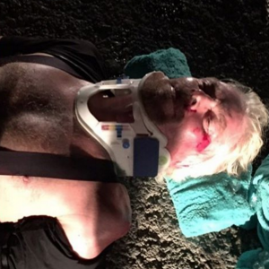 Richard Branson dévoile ses blessures sur Instagram après une violente chute à vélo, août 2016.