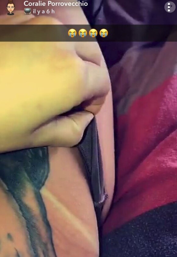 Coralie Porrovecchio brûlée lors d'une séance d'U.V, Snapchat, février 2018