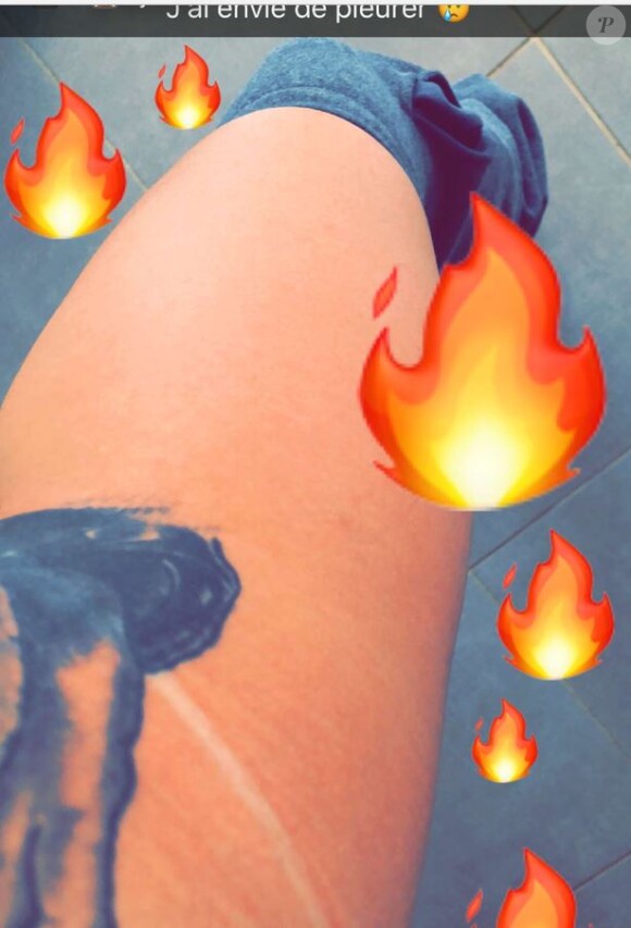 Coralie Porrovecchio brûlée lors d'une séance d'U.V, Snapchat, février 2018