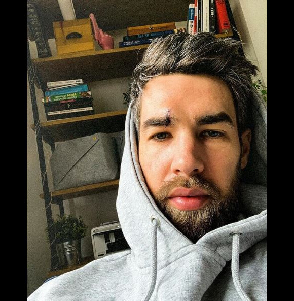 Luka Karabatic blessé à l'arcade sourcilière. Instagram, le 11 février 2019. 