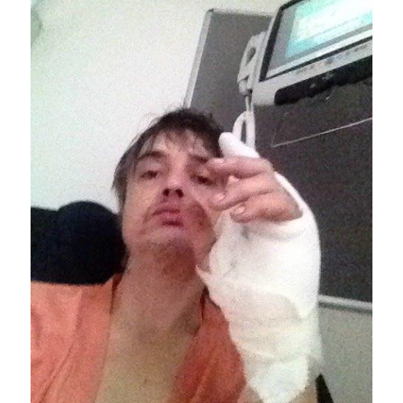 Pete Doherty annonce, ce 30 avril 2019, avoir été hospitalisé en raison d'une blessure qui s'est infectée à la main. Le rockeur s'est piqué sur un hérisson.