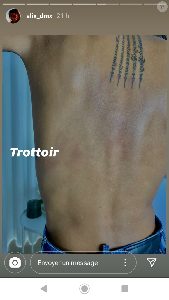 Alix des "Marseillais" dévoile de nouvelles photos de ses blessures après sa violente agression à Marbella, le 30 juillet 2020