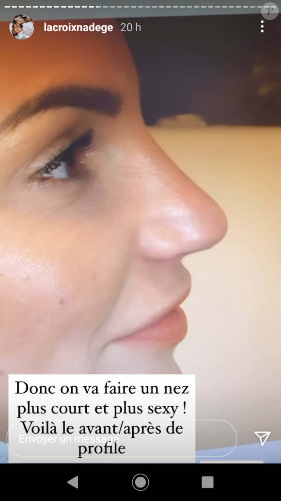 Nadège Lacroix fait une nouvelle rhinoplastie, le 8 décembre 2020