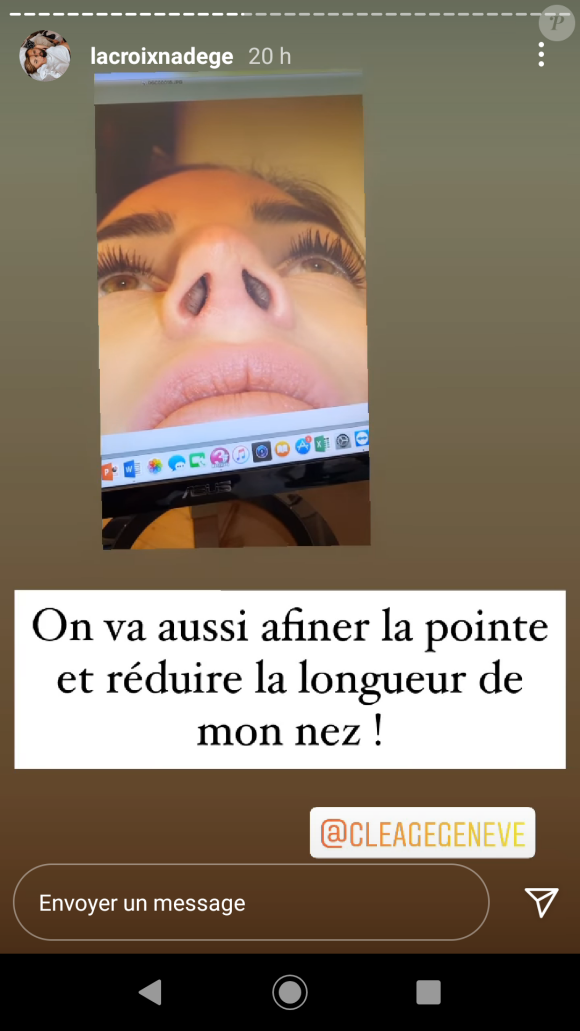Nadège Lacroix fait une nouvelle rhinoplastie, le 8 décembre 2020