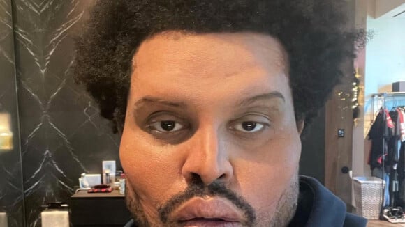 The Weeknd métamorphosé : il retire ses bandages et dévoile son nouveau visage