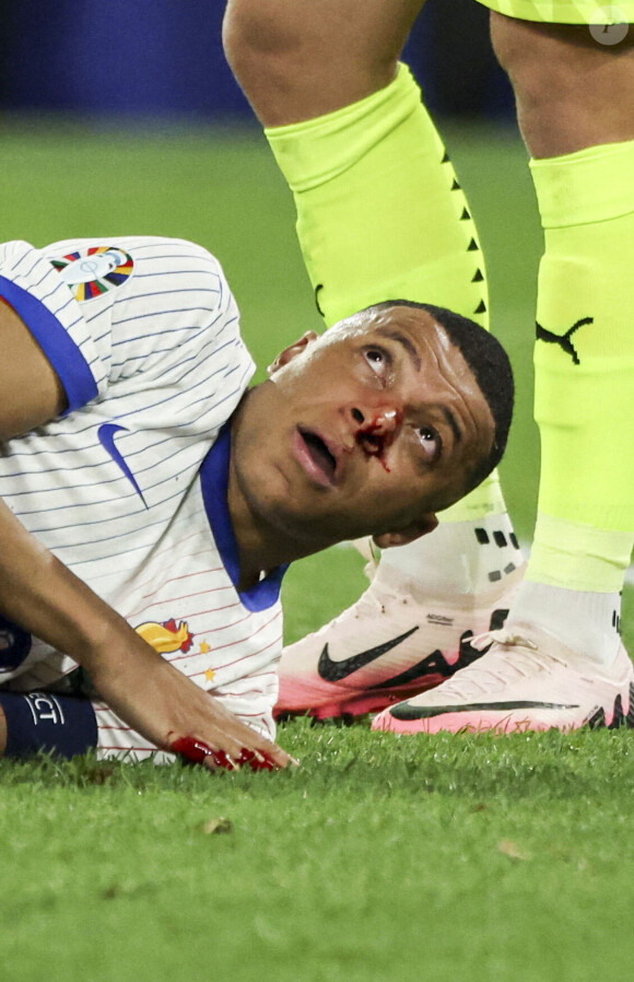 L'attaquant des Bleus s'est fracturé le nez lors du premier match de l'Euro 2024 face à l'Autriche
 
Kylian Mbappé a été victime d'une fracture du nez lors du du match du groupe D de l'Euro 2024 entre l'équipe de France face à l'Autriche (1-0) à Dusseldorf en Allemagne le 17 jun 2024. Sorti avec le nez cassé après un choc avec Kevin Danso, Kylian Mbappé a passé des premiers examens qui laissent place à l'optimisme. L'intervention chirurgicale est écartée " dans l'immédiat ", selon la FFF.