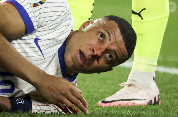 Kylian Mbappé a été victime d'une fracture du nez lors du du match du groupe D de l'Euro 2024 entre l'équipe de France face à l'Autriche (1-0) à Dusseldorf en Allemagne le 17 jun 2024. Sorti avec le nez cassé après un choc avec Kevin Danso, Kylian Mbappé a passé des premiers examens qui laissent place à l'optimisme. L'intervention chirurgicale est écartée « dans l'immédiat », selon la FFF.