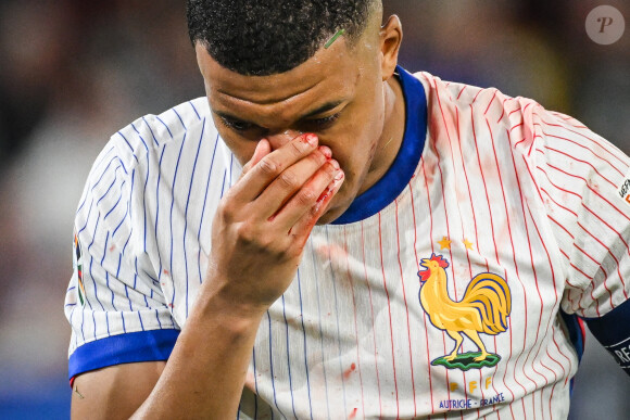 Kylian Mbappé a été victime d'une fracture du nez lors du du match du groupe D de l'Euro 2024 entre l'équipe de France face à l'Autriche (1-0) à Dusseldorf en Allemagne le 17 jun 2024. Sorti avec le nez cassé après un choc avec Kevin Danso, Kylian Mbappé a passé des premiers examens qui laissent place à l'optimisme. L'intervention chirurgicale est écartée « dans l'immédiat », selon la FFF.