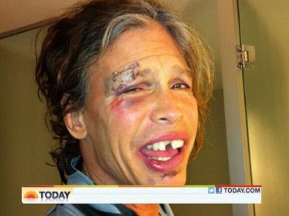 Le visage de Steven Tyler après sa chute le 25 octobre 2011 dans la salle de bain de sa chambre d'hôtel, au Paraguay.