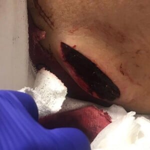 La blessure au couteau de Miles Hurley, neveu d'Elizabeth Hurley. Mars 2018.