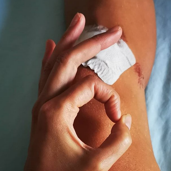 Mardi 13 août 2019, Laury Thilleman a fait une violente chute à vélo. Elle a été hospitalisée et a eu cinq point de suture.
