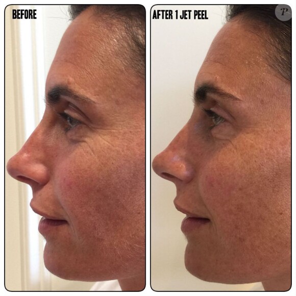 Alessandra Sublet et ses résultats bluffants après son "Jet Peel", inovation du lifting sans injection- 21 août 2019.