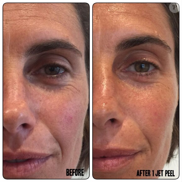 Alessandra Sublet et ses résultats bluffants après son "Jet Peel", inovation du lifting sans injection- 21 août 2019.
