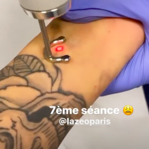 Caroline Receveur se fait enlever son tatouage au laser, sur Instagram le 19 décembre 2019.