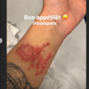 Caroline Receveur se fait enlever son tatouage au laser, sur Instagram le 19 décembre 2019.
