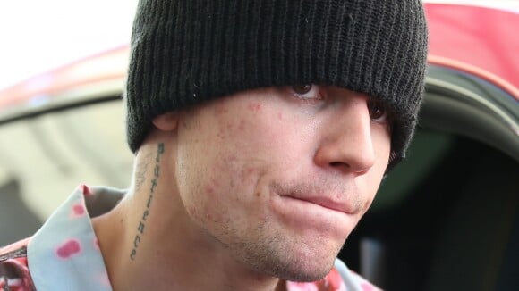 Justin Bieber et son acné d'adulte : comment il tente de dissimuler ses boutons