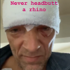 Vincent Cassel dévoile son visage tuméfié sur Instagram, le 22 mai 2020. L'acteur a été victime d'un accident de scooter près de Biarritz, le 20 mai.