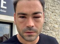 Ricardo (Les Anges), défiguré à cause d'un poulpe, raconte son calvaire