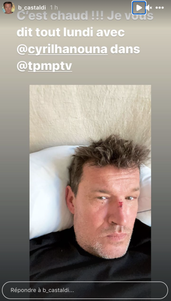 Benjamin Castaldi avec le nez cassé sur Instagram. Il expliquera sa mésaventure sur le plateau de TPMP prochainement.