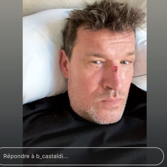 Benjamin Castaldi avec le nez cassé sur Instagram. Il expliquera sa mésaventure sur le plateau de TPMP prochainement.