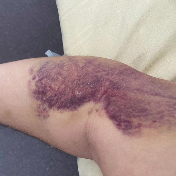 Moundir a dévoilé des photos de sa convalescence après avoir lutté contre la Covid-19.