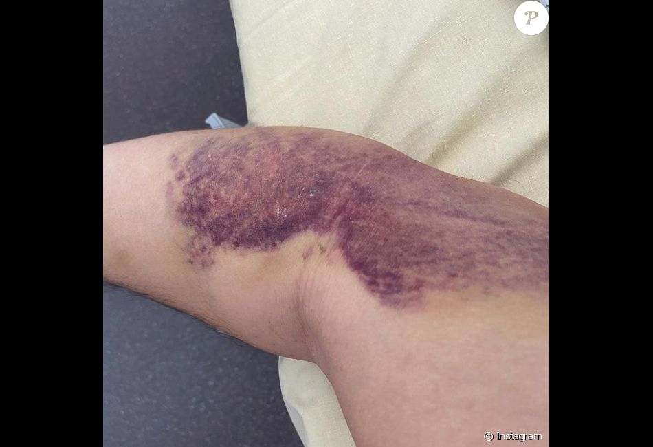 Moundir a dévoilé des photos de sa convalescence après avoir lutté contre la Covid-19.