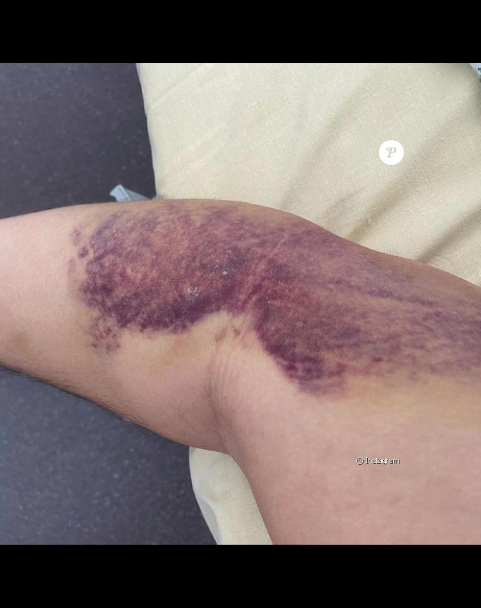 Moundir a dévoilé des photos de sa convalescence après avoir lutté contre la Covid-19.