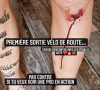 Alix (Koh-Lanta) dévoile une photo de sa grosse blessure à la jambe après un accident à vélo - Instagram