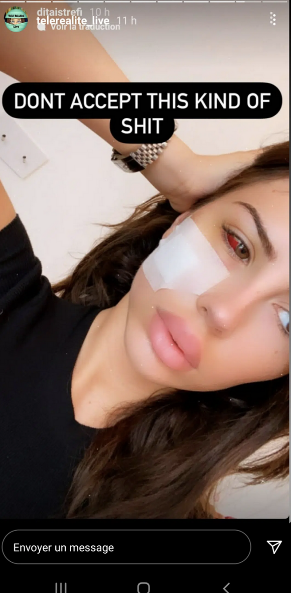 Dita Istrefi donne de ses nouvelles après son opération et dévoile son visage amoché par les coups de son ex-compagnon - Instagram