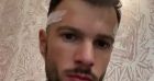 Hugo Philip partage son opération de greffe capillaire sur Instagram.