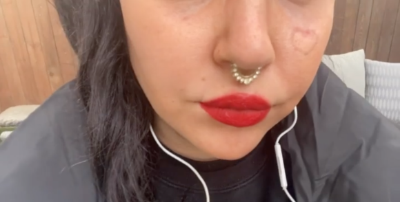 Amanda Bynes se fait effacer son tatouage au visage, un coeur qu'elle possédait à la pomette gauche. Mars 2022.
