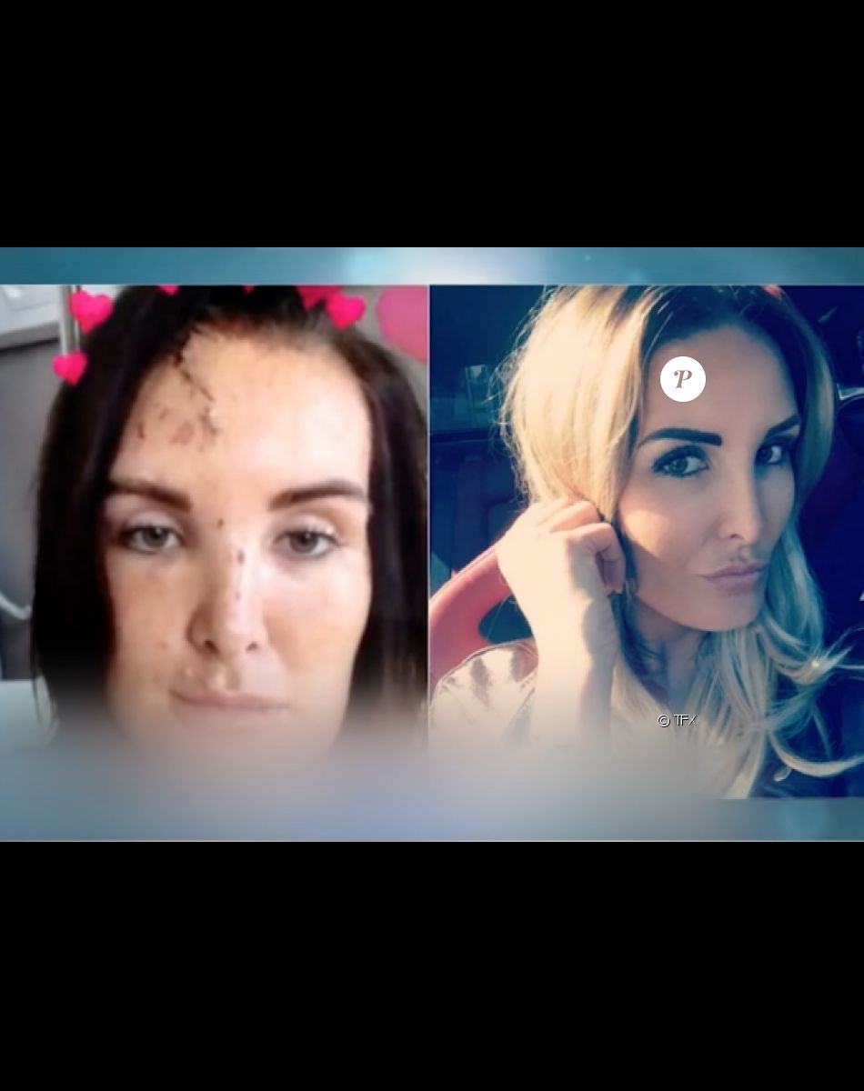 Marie Garet, ex-candidate de télé-réalité défigurée après son accident de la route en 2017.